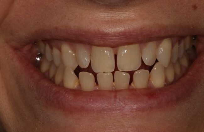 Before (Teeth)