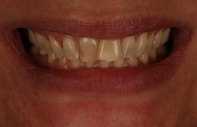 Before (Teeth)