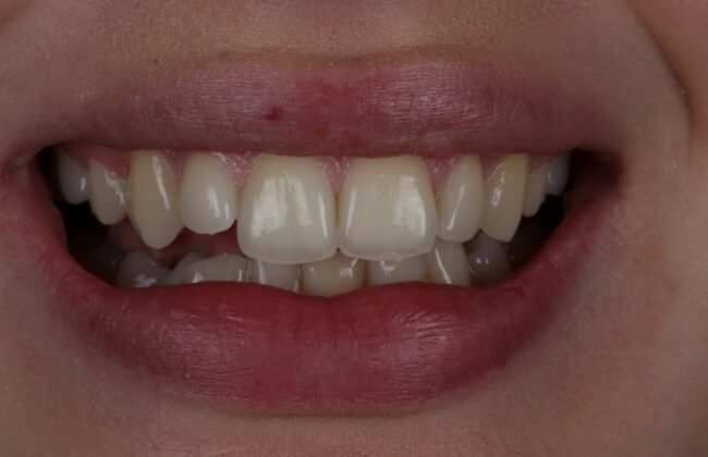 Before (Teeth)