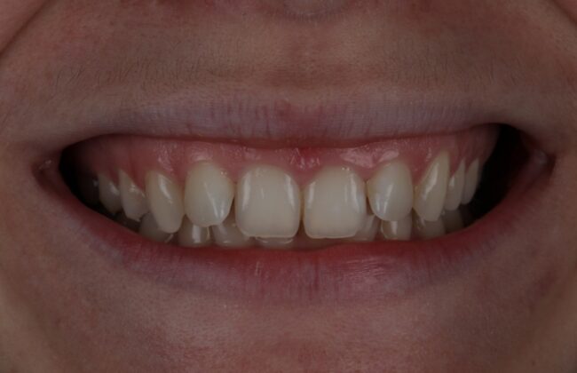 After (Teeth)