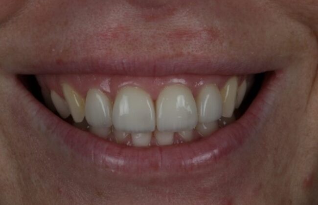 After (Teeth)