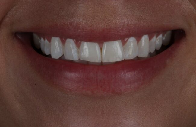 Before (Teeth)