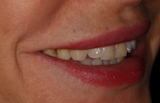 Before (Teeth)