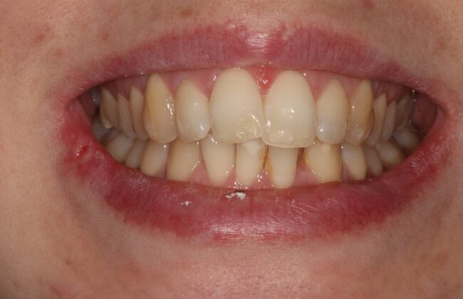 Before (Teeth)