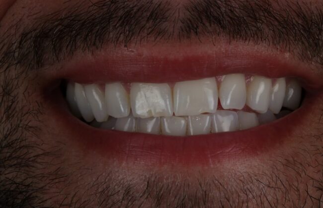 Before (Teeth)