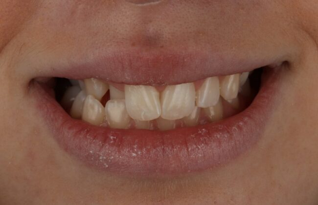 Before (Teeth)
