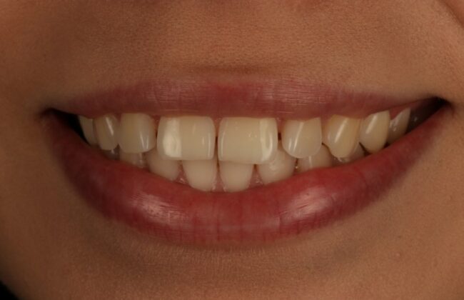 Before (Teeth)
