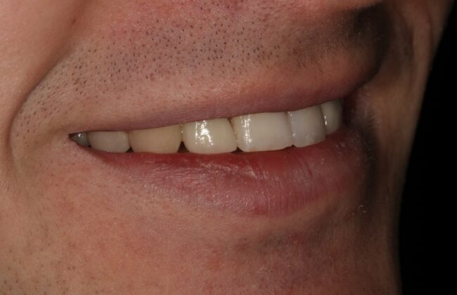 After (Teeth)