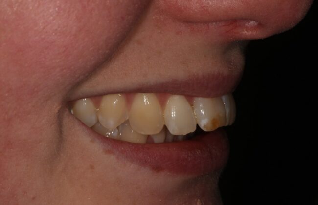 Before (Teeth)
