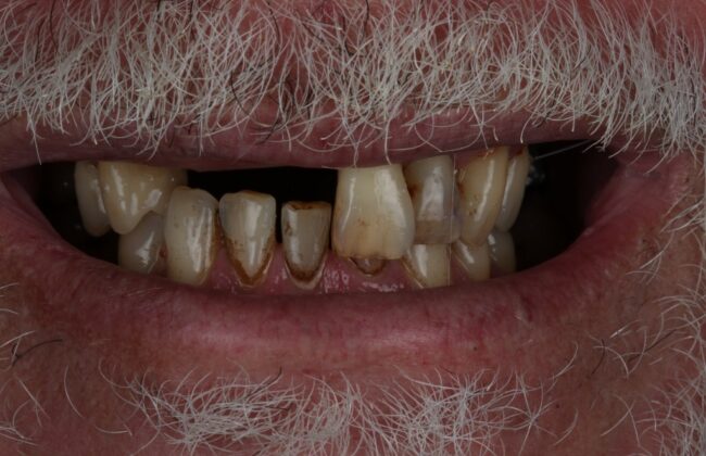 Before (Teeth)