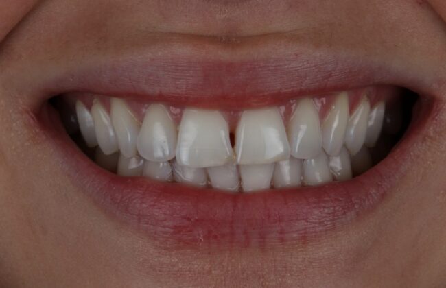 Before (Teeth)