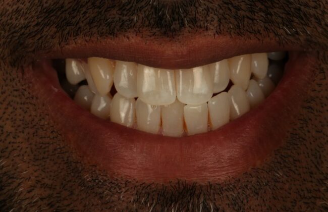 Before (Teeth)