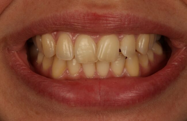 Before (Teeth)