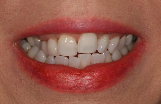Before (Teeth)