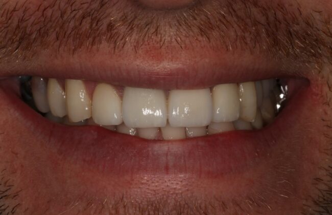 After (Teeth)