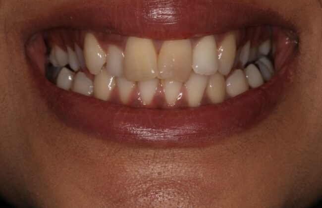 Before (Teeth)