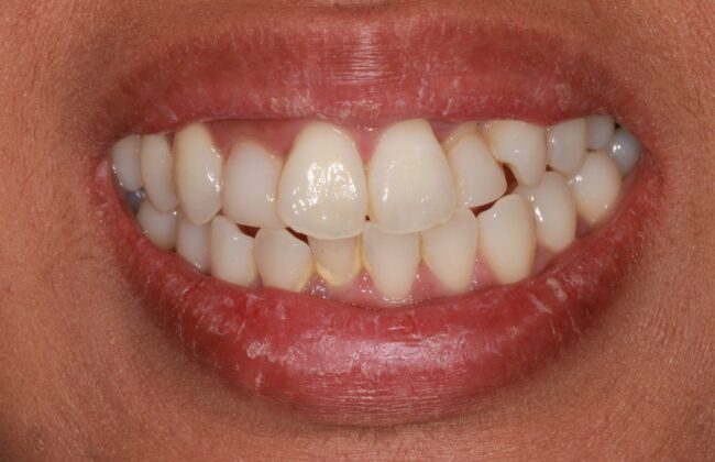 Before (Teeth)