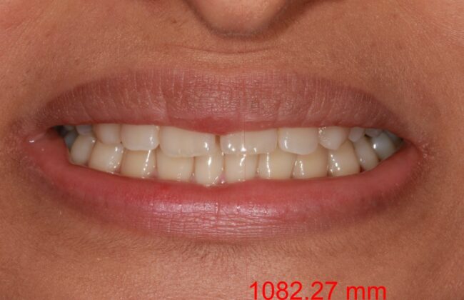 Before (Teeth)