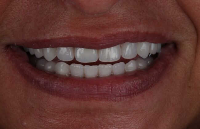 After (Teeth)