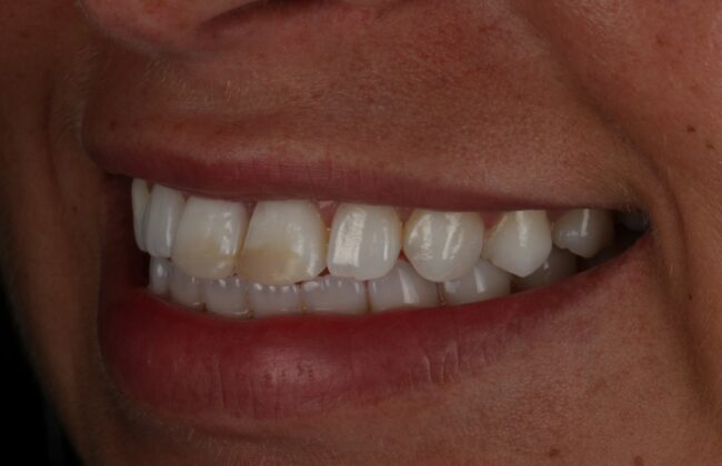 Before (Teeth)