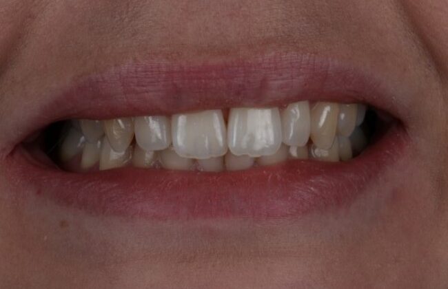 Before (Teeth)