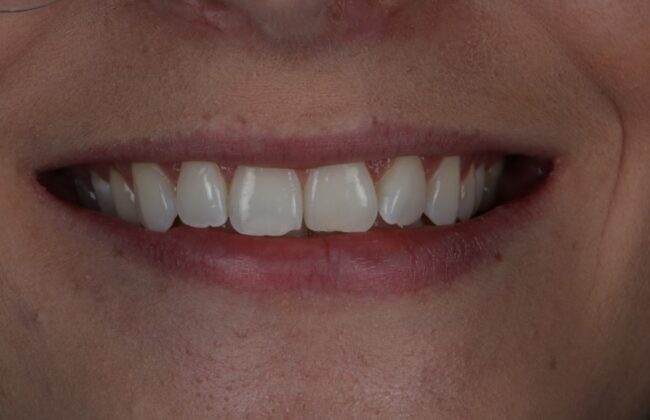Before (Teeth)