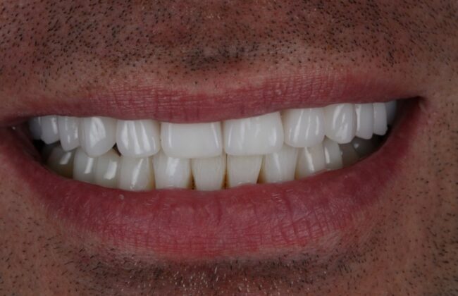 After (Teeth)
