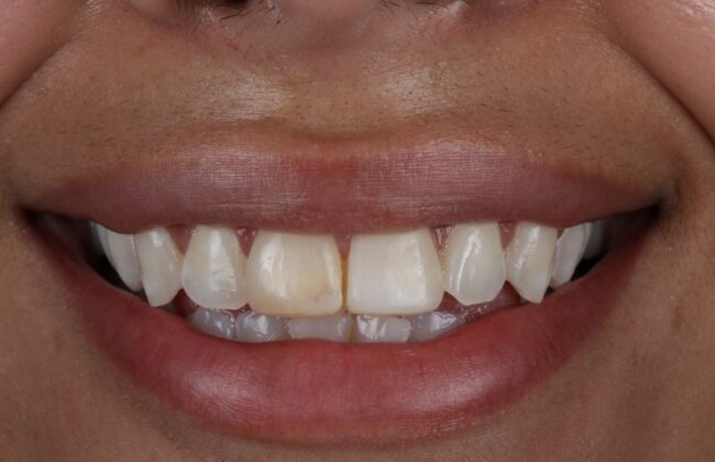 Before (Teeth)