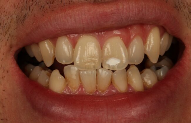 Before (Teeth)