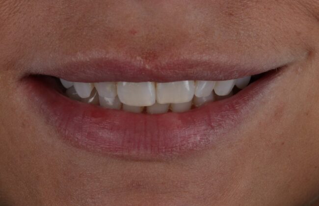 Before (Teeth)