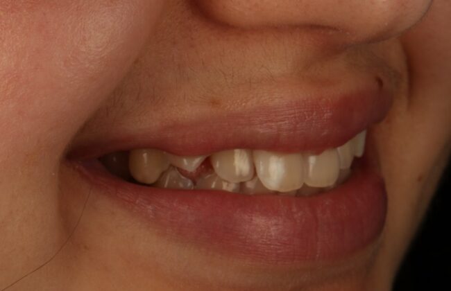 Before (Teeth)