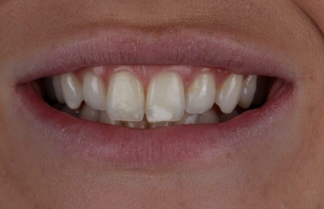 Before (Teeth)