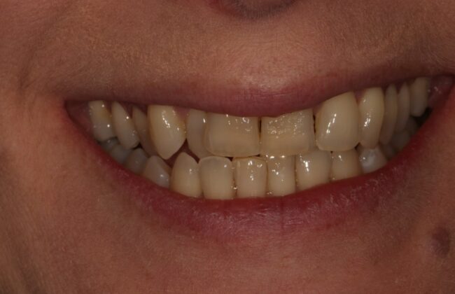 Before (Teeth)