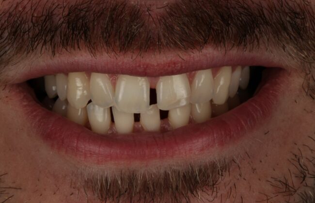 Before (Teeth)