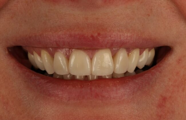After (Teeth)