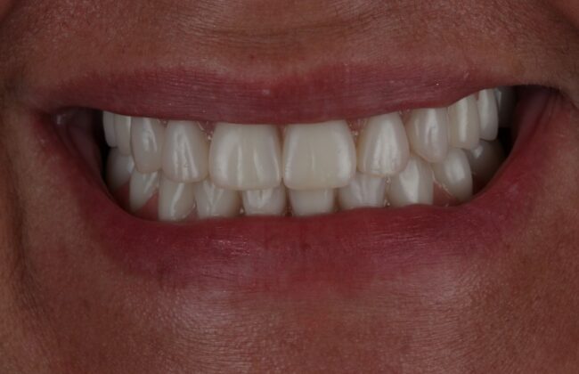 After (Teeth)
