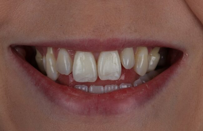 Before (Teeth)