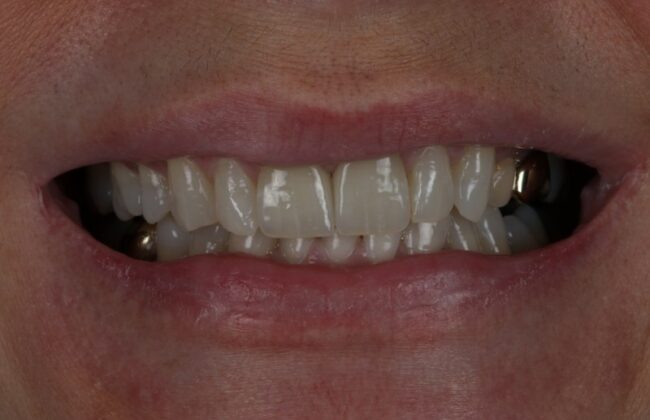 After (Teeth)