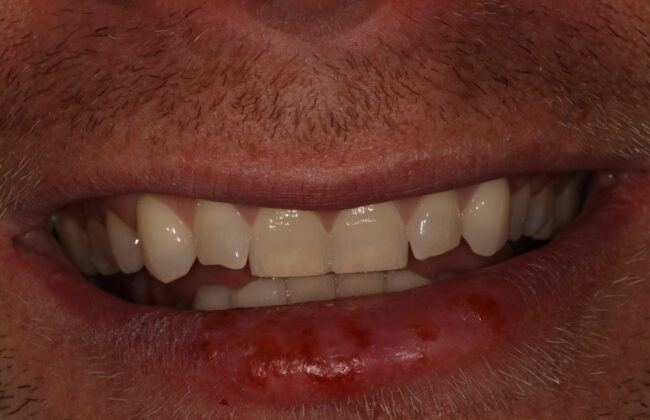 Before (Teeth)