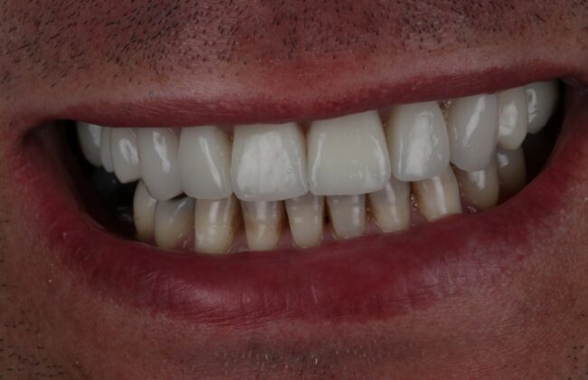 After (Teeth)