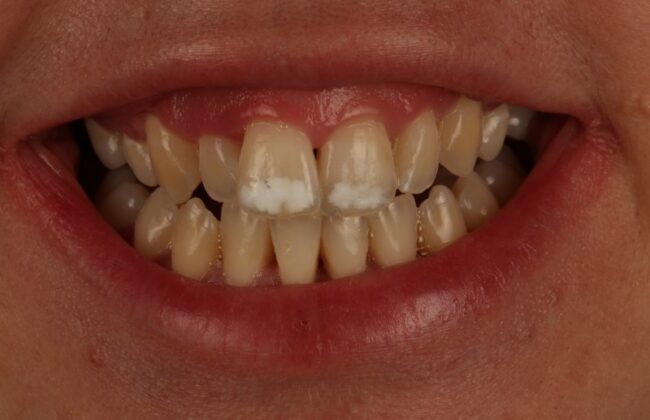 Before (Teeth)