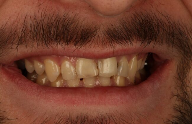 Before (Teeth)