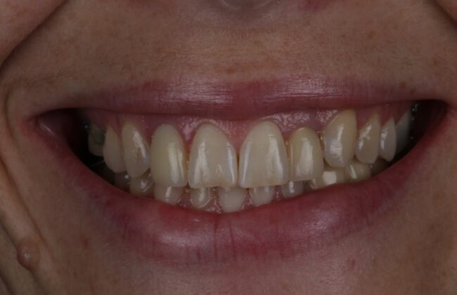 Before (Teeth)