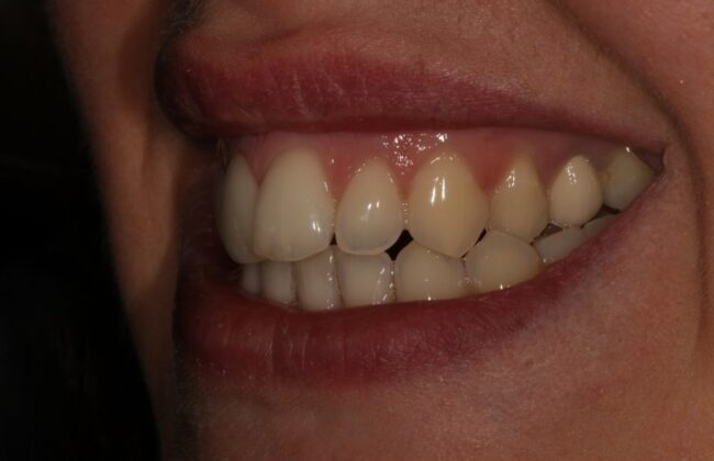 Before (Teeth)