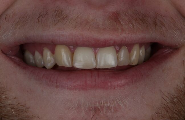 Before (Teeth)