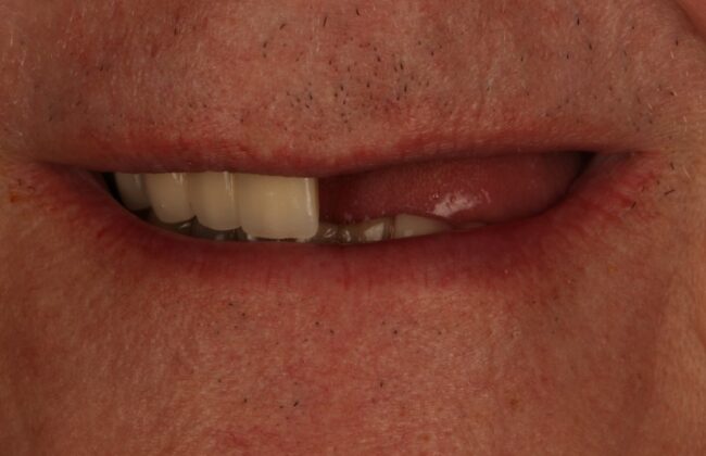 Before (Teeth)