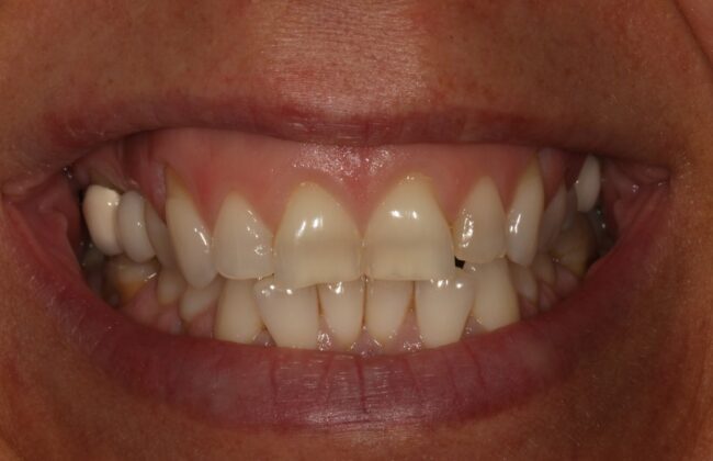 Before (Teeth)