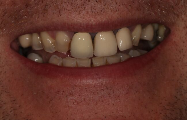 Before (Teeth)