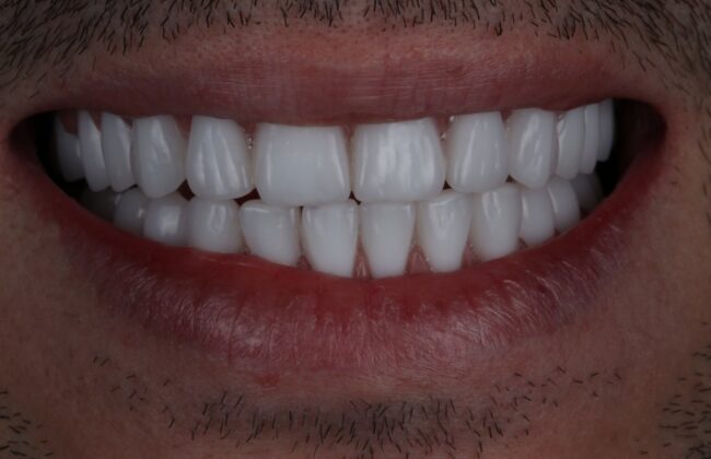 After (Teeth)