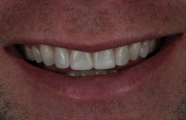 After (Teeth)